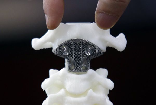 3D printed vertebrae