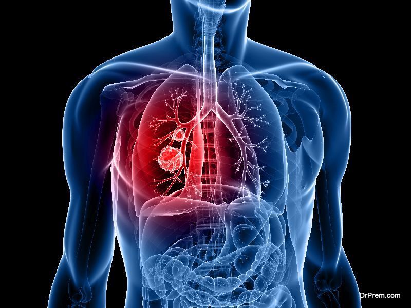 lung-cancer-