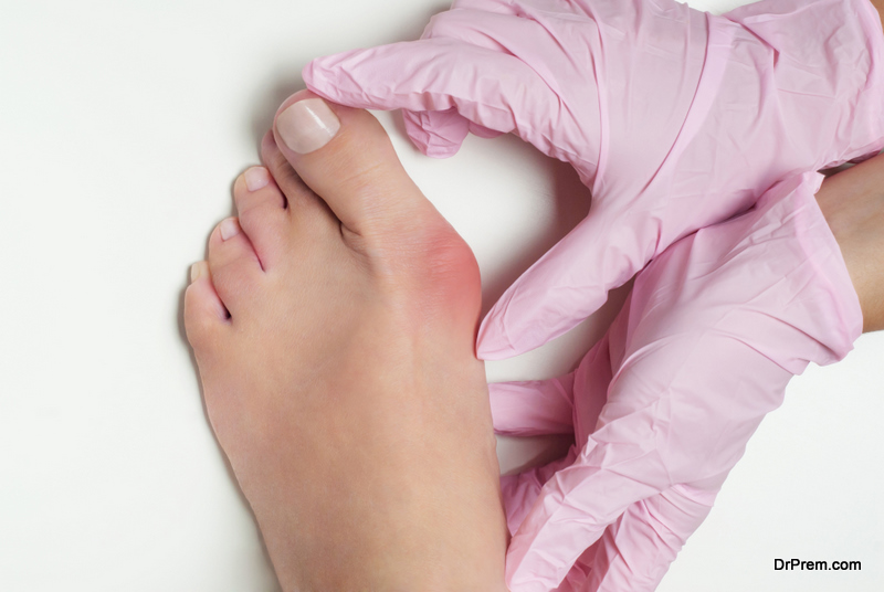 A Guide on How to Prevent Bunions